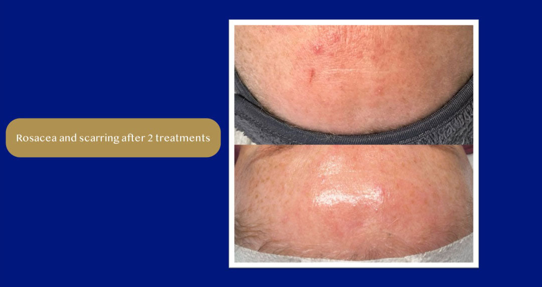 AMiKO CMCA PEEL: Colostrum, AHA, BHA, and MCA peel (5 x 10ml)