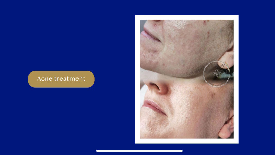 AMiKO CMCA PEEL: Colostrum, AHA, BHA, and MCA peel (5 x 10ml)