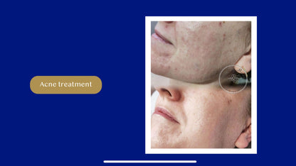 AMiKO CMCA PEEL: Colostrum, AHA, BHA, and MCA peel (5 x 10ml)