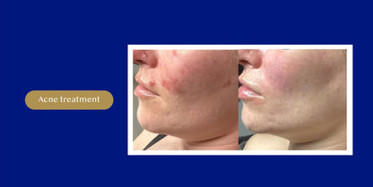AMiKO CMCA PEEL: Colostrum, AHA, BHA, and MCA peel (5 x 10ml)